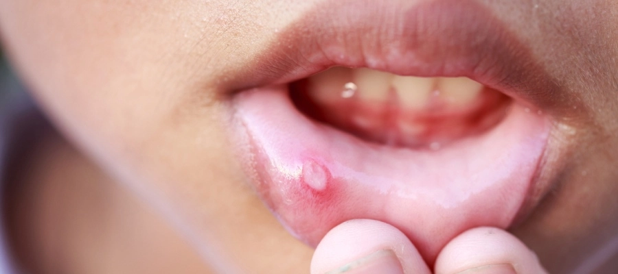 Imagem do post Imunidade baixa e sintomas na boca: 7 principais sinais de alerta