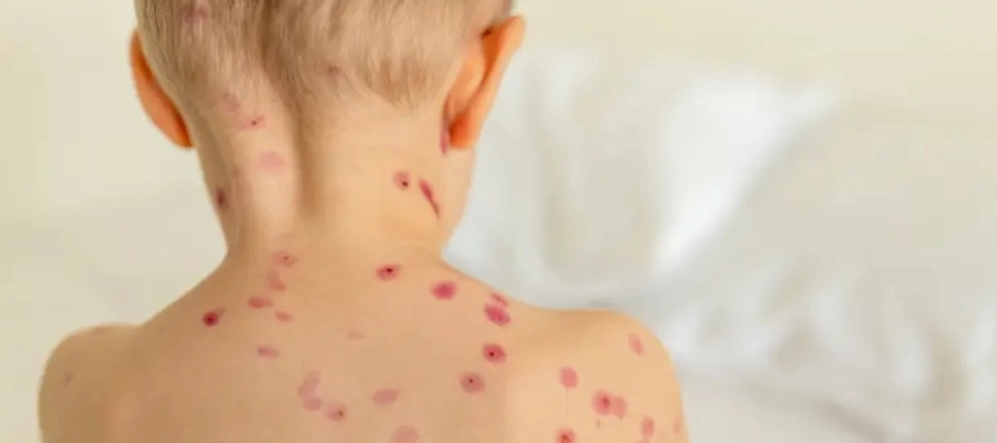 Transmissão da Mpox