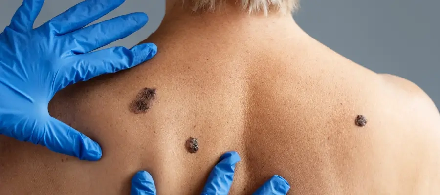 Mpox